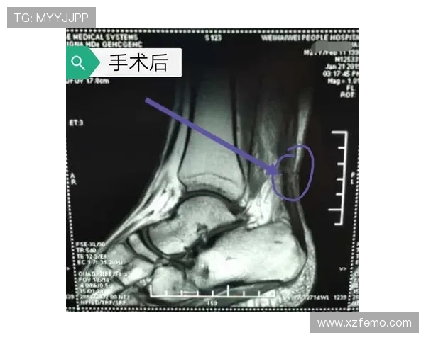 小卢卡斯右腿跟腱断裂已手术